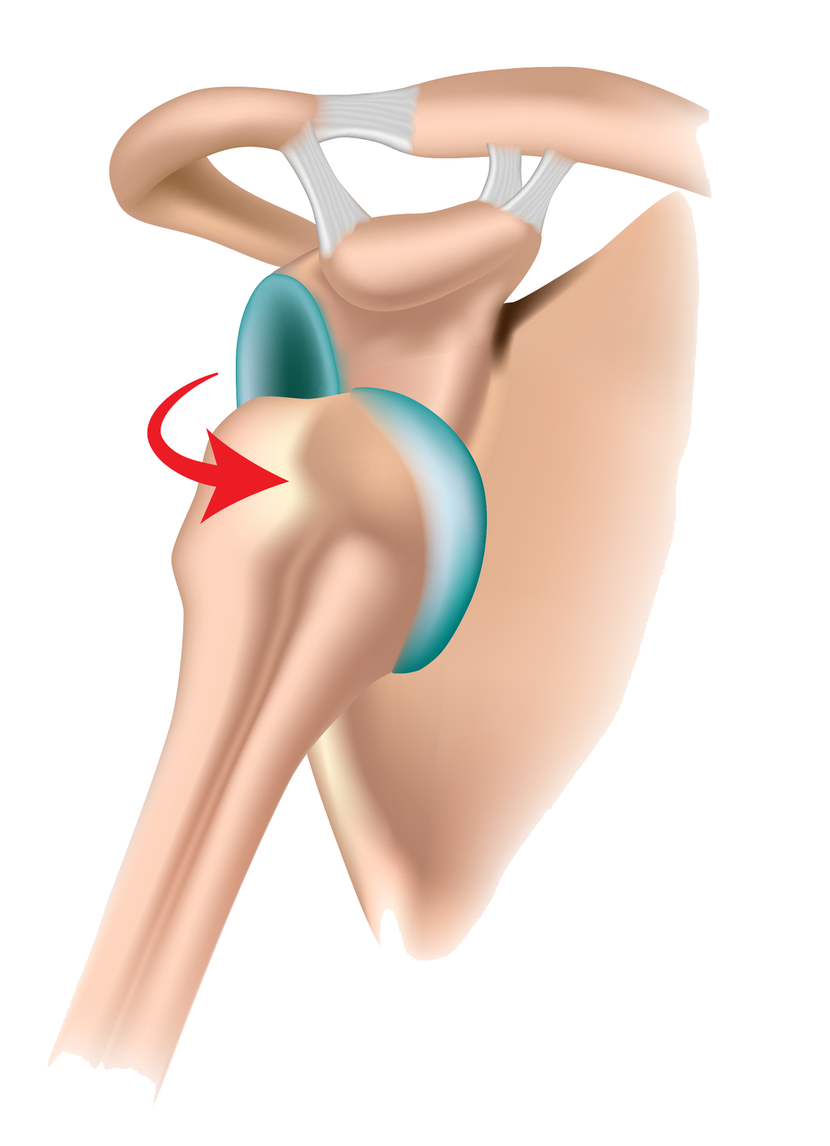 Traumatic shoulder instability